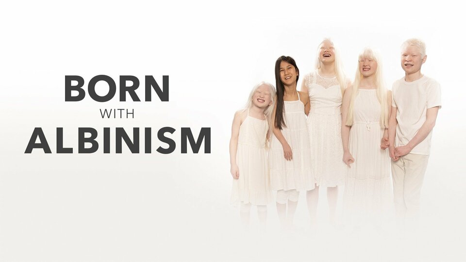 Born With Albinism - TLC